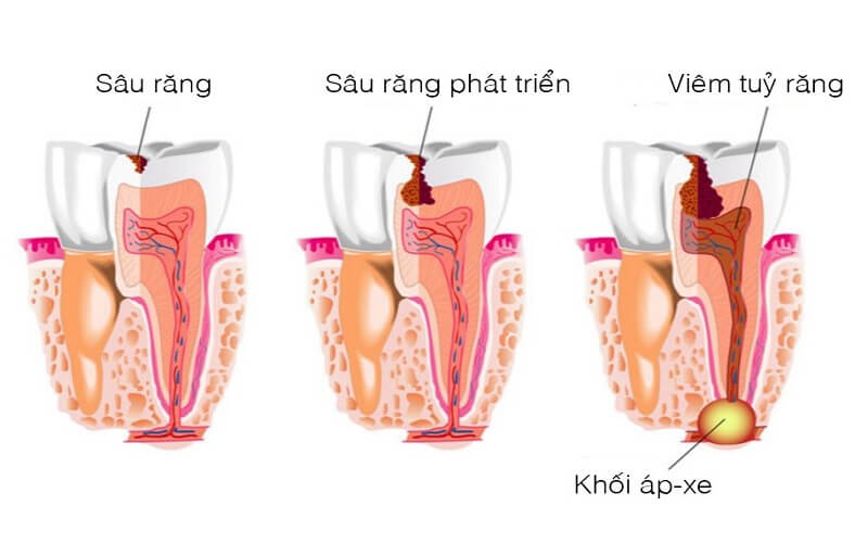 ap-xe-rang