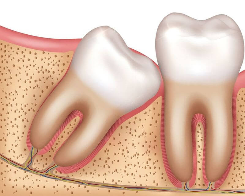 Răng khôn thường mọc ở độ tuổi từ 18 - 21 tuổi