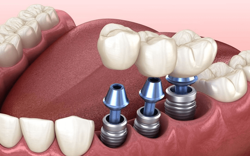 cay-ghep-implant