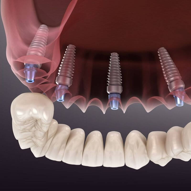 Cấy ghép Implant là quá trình ghép những ốc vít bằng kim loại sinh học vào xương hàm