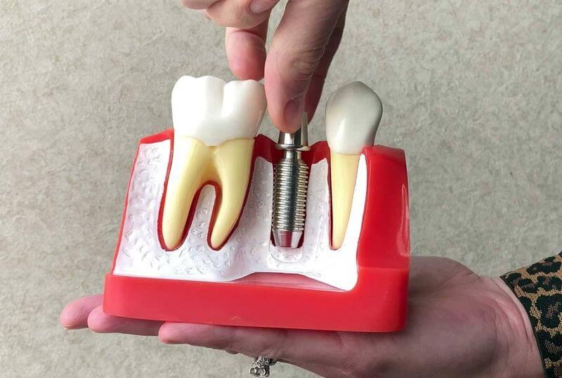 Sau khi cấy ghép sẽ mất khoảng 1 đến 3 tháng để trụ Implant và xương hàm dính vào nhau