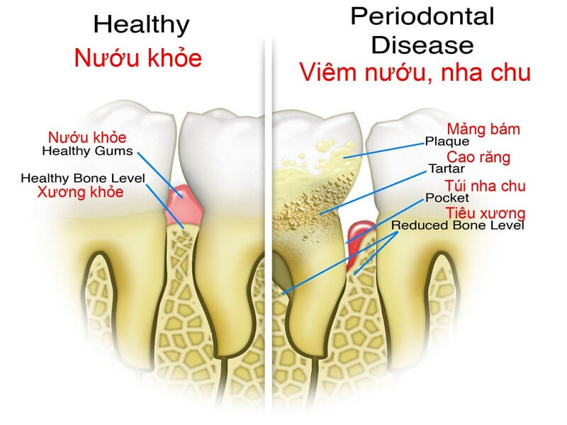 Nha chu hình thành từ các mảng bám ở chân răng