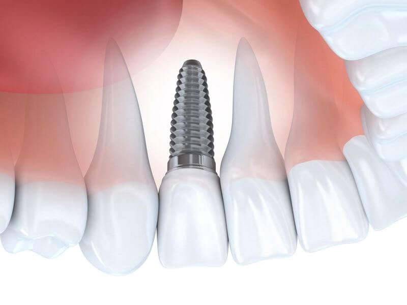 Quá trình cấy ghép Implant được thực hiện trong khoảng thời gian từ 10 - 15 phút tùy trường hợp