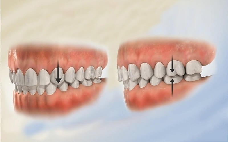 Bọc răng sứ giúp cải thiện tình trạng sai lệch khớp cắn