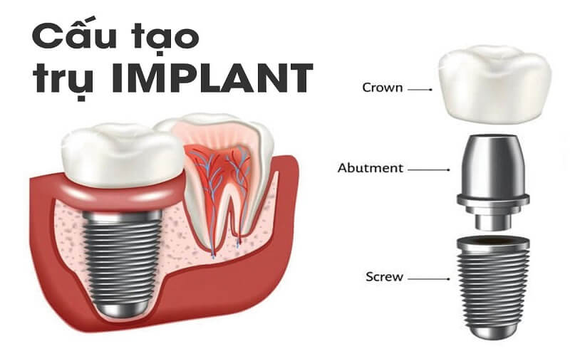 cay-ghep-implant-o-tphcm