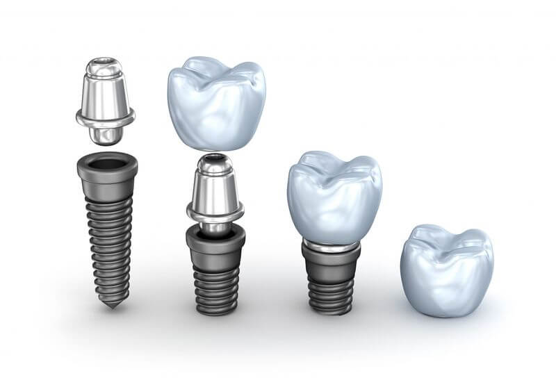 Chi phí trồng răng Implant phụ thuộc vào rất nhiều yếu tố