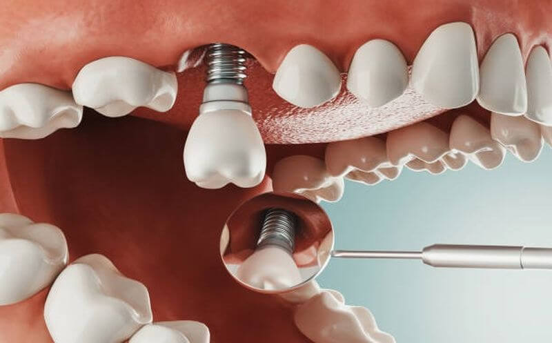 Cấy ghép Implant - Phương pháp phục hình răng hiệu quả và chất lượng nhất hiện nay