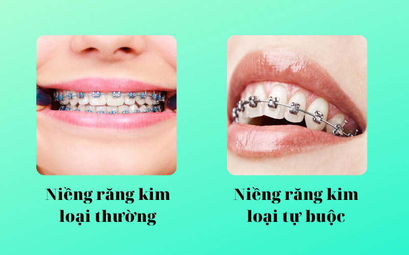 Niềng răng mắc cài tự buộc và niềng răng mắc cài thường