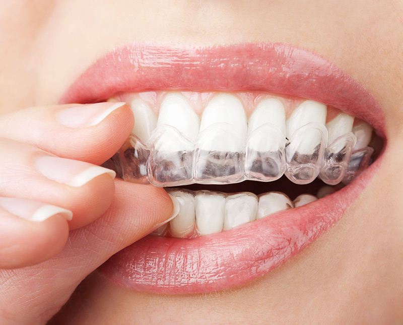 Chỉnh nha không mắc cài Invisalign