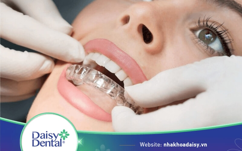 Mỗi khay niềng Invisalign đeo được 1 - 2 tuần