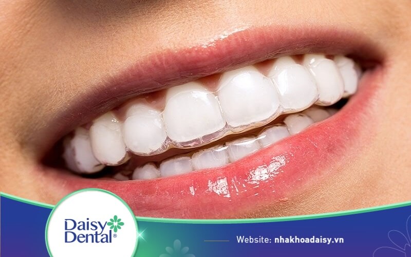 Khay niềng răng invisalign thẩm mỹ cao