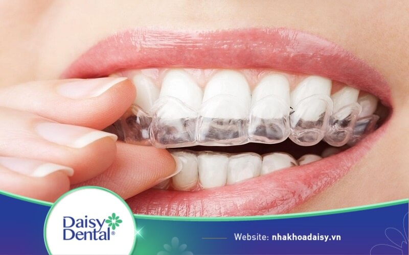 Cảm giác khó chịu khi đeo niềng invisalign sẽ biến mất sau vài ngày