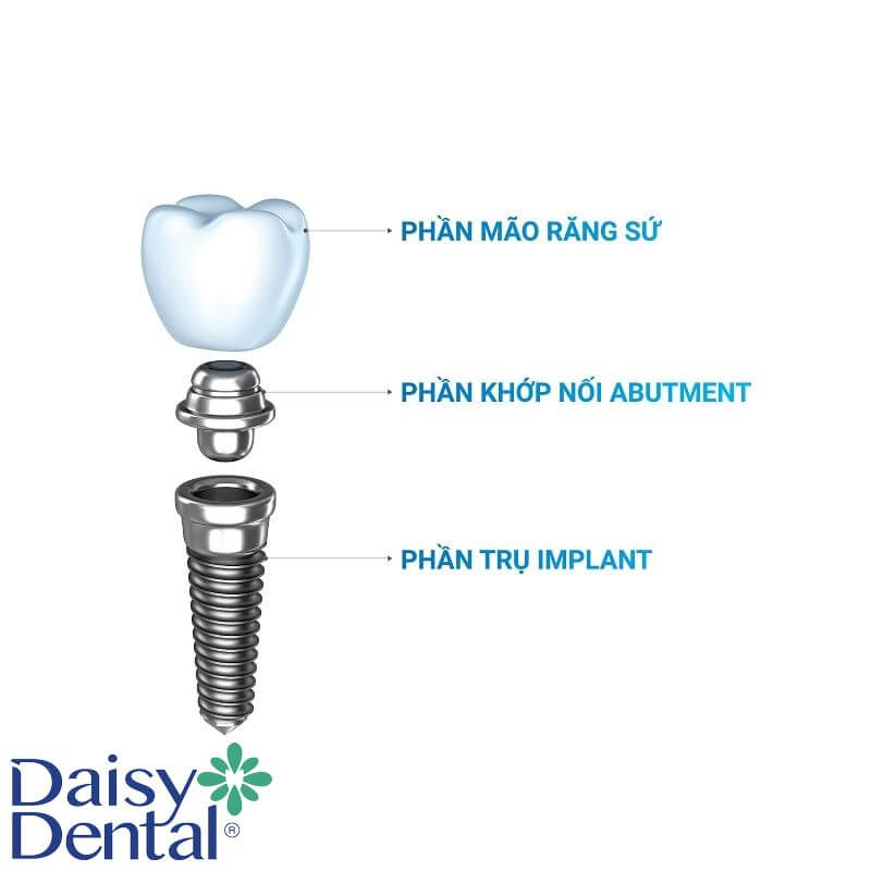 Cấu trúc răng Implant được chia làm 3 phần