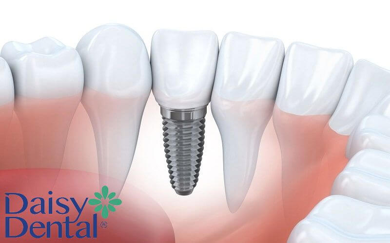 Thời gian trồng răng implant bao lâu phụ thuộc vào nhiều yếu tố