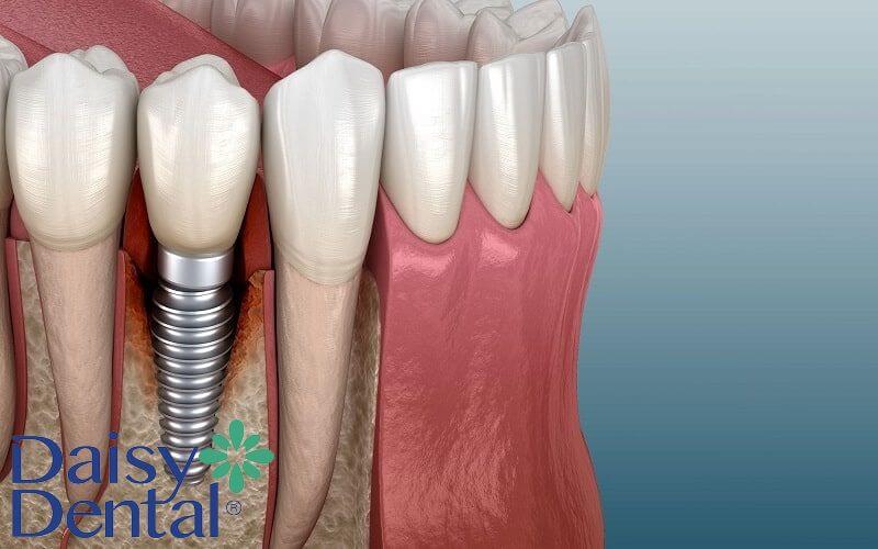 Trồng răng implant là phương pháp phục hình răng mới nhất hiện nay