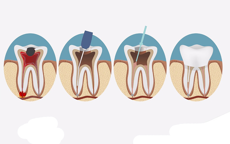 Bác sĩ tiến hành điều trị nội nha, làm sạch vùng tủy bị nhiễm khuẩn