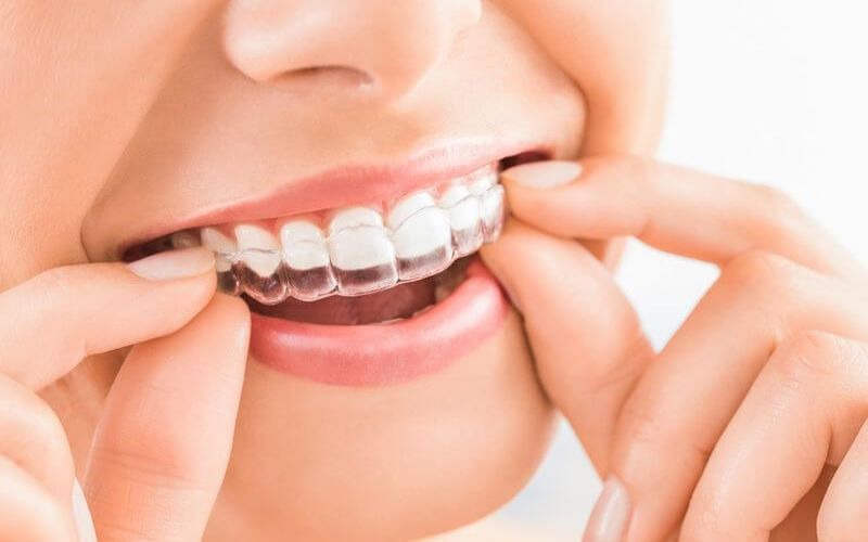 Niềng răng Invisalign với tính thẩm mỹ cao