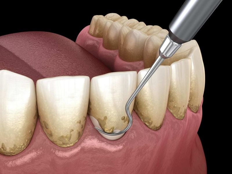 Răng cửa bị sẫm màu, có vớt ố trên răng