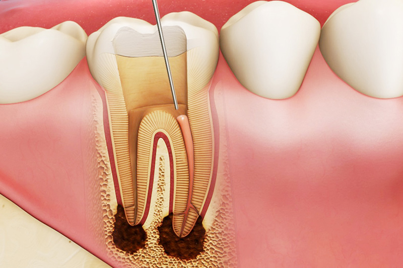 Viêm tủy gây ra tình trạng sưng xung quanh nướu răng