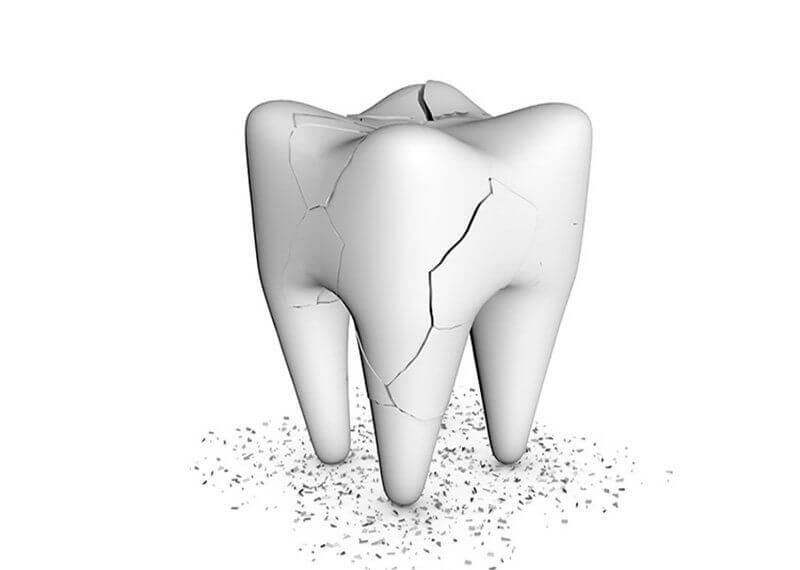 Răng bị va đập, gây chấn thương, bể, sứt mẻ từ đó làm đau nhức răng