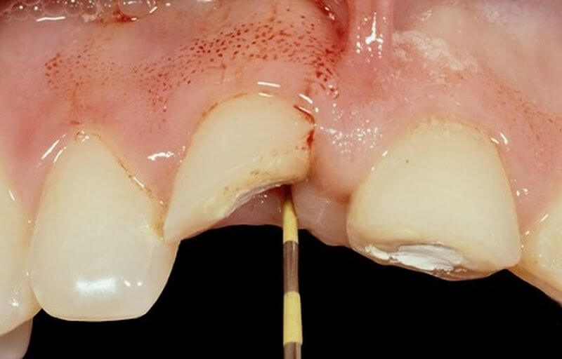 Răng sứt mẻ, lung lay do tai nạn