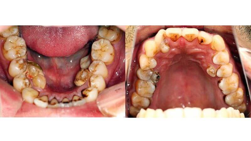 Trường hợp răng mọc nhiều và lòi sĩ