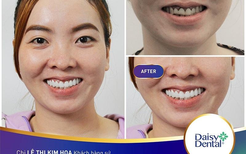 Khách hàng chị Thoa sở hữu hàm răng đẹp tự nhiên như thật sau khi bọc sứ tại DAISY DENTAL