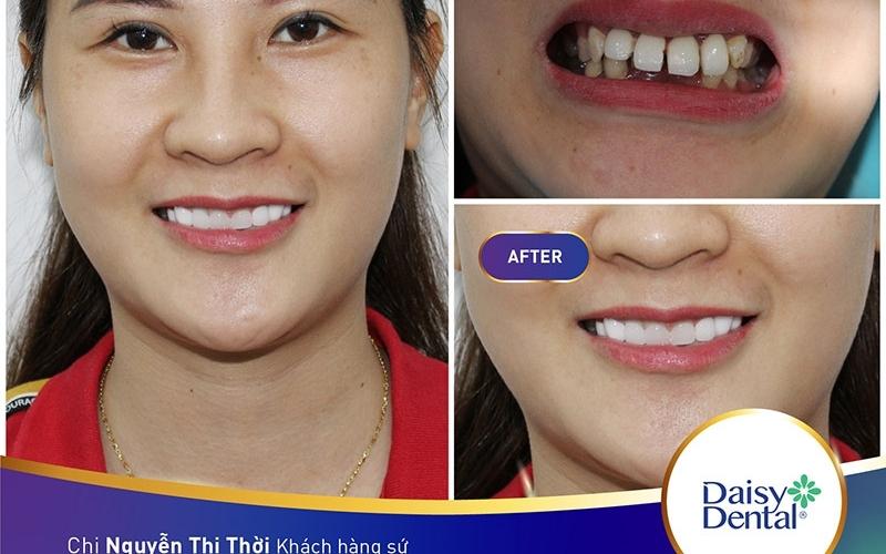 Khách hàng chị Thời thực hiện bọc răng sứ Zirconia 8 răng tại DAISY DENTAL