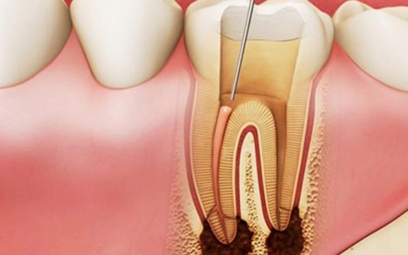 Nếu chưa điều trị bệnh lý răng miệng, khách hàng dễ bị viêm tủy răng